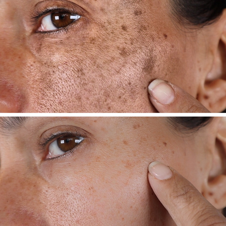 (🔥LAST DAY SALE-80% OFF)-Fast Dark Spot Remover-NESLEMY™ Turmeric Spot Repair Serum