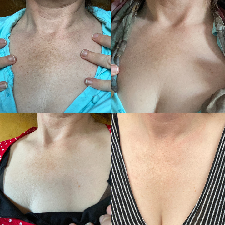 (🔥LAST DAY SALE-80% OFF)-Fast Dark Spot Remover-NESLEMY™ Turmeric Spot Repair Serum