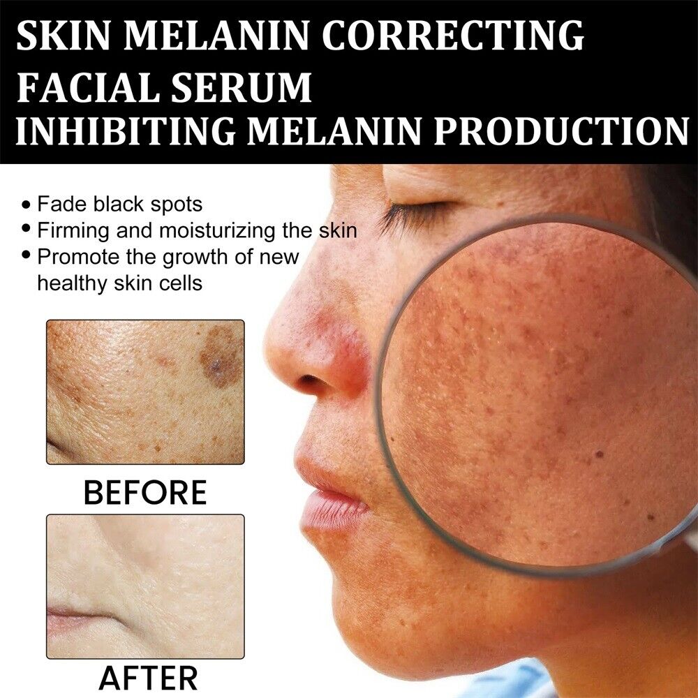 (🔥LAST DAY SALE-80% OFF)-Fast Dark Spot Remover-NESLEMY™ Turmeric Spot Repair Serum