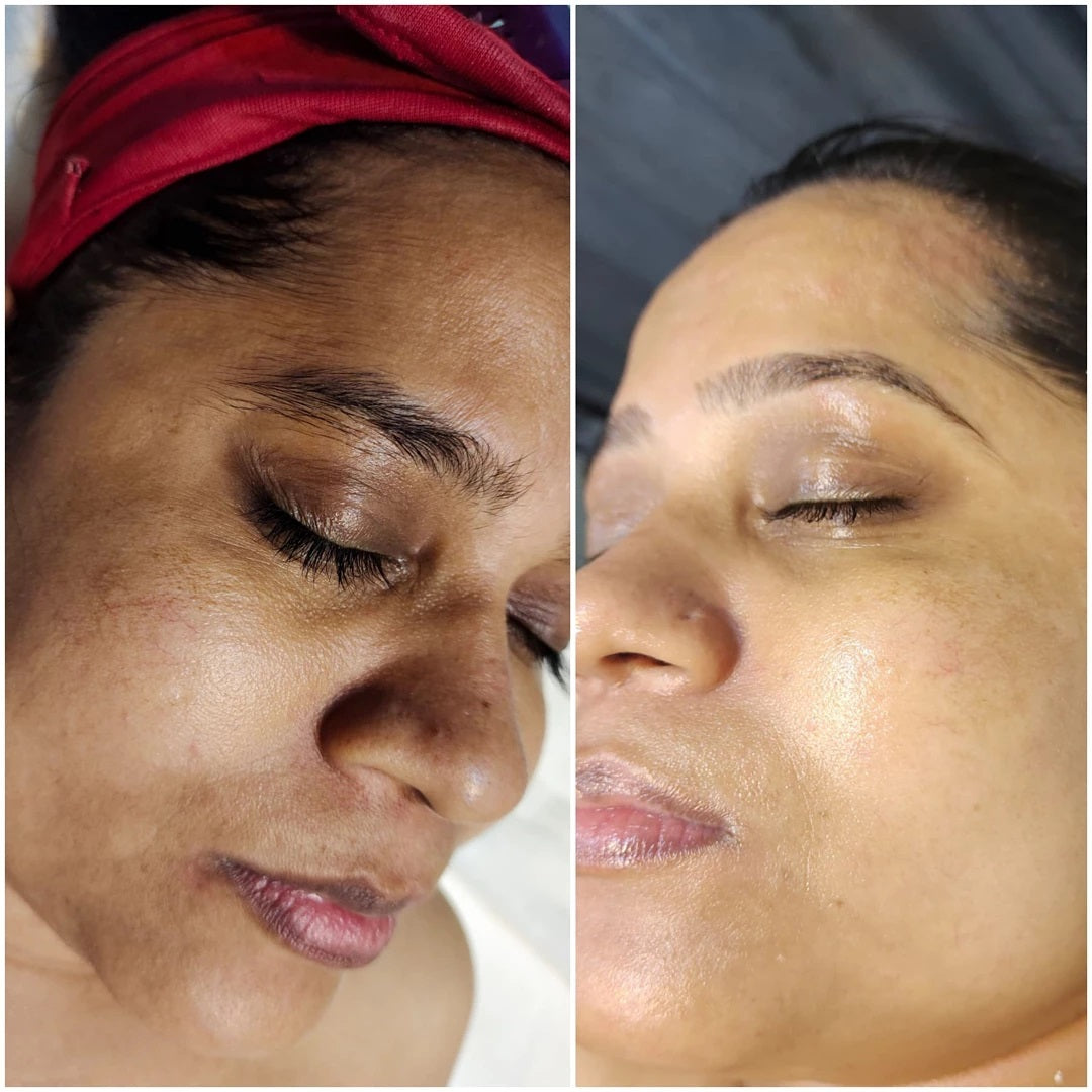 (🔥LAST DAY SALE-80% OFF)-Fast Dark Spot Remover-NESLEMY™  Turmeric Spot Repair Serum